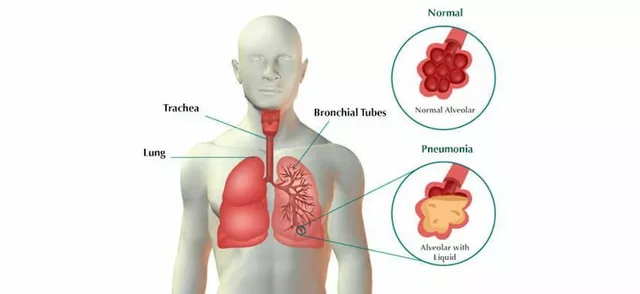 Pneumonia and Diabetes: What You Should Know