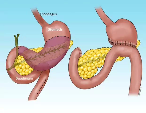 The Connection between Atrophic Gastroenteritis and Gastric Cancer